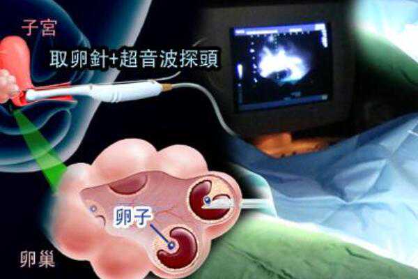 北京供卵代生费用表查询,北京哪家私立医院做二胎试管婴儿比较权威？,北京哪